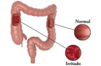 do intestino irritável Artricenter síndrome